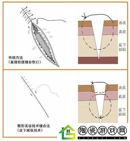 竹板打肿臂缝合不上：真能发生吗