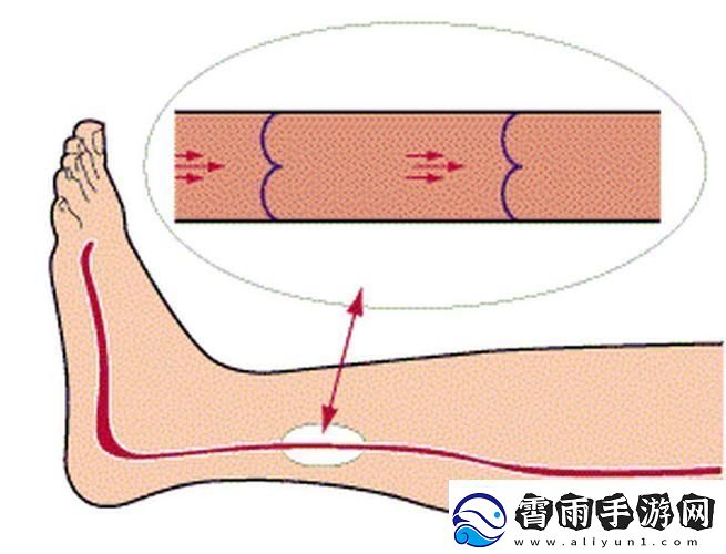 科技狂潮里的美腿秘籍：静脉里的创新舞者