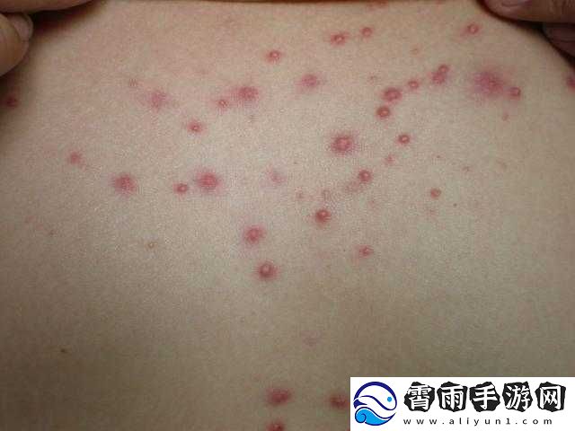女性莲花开症状图片